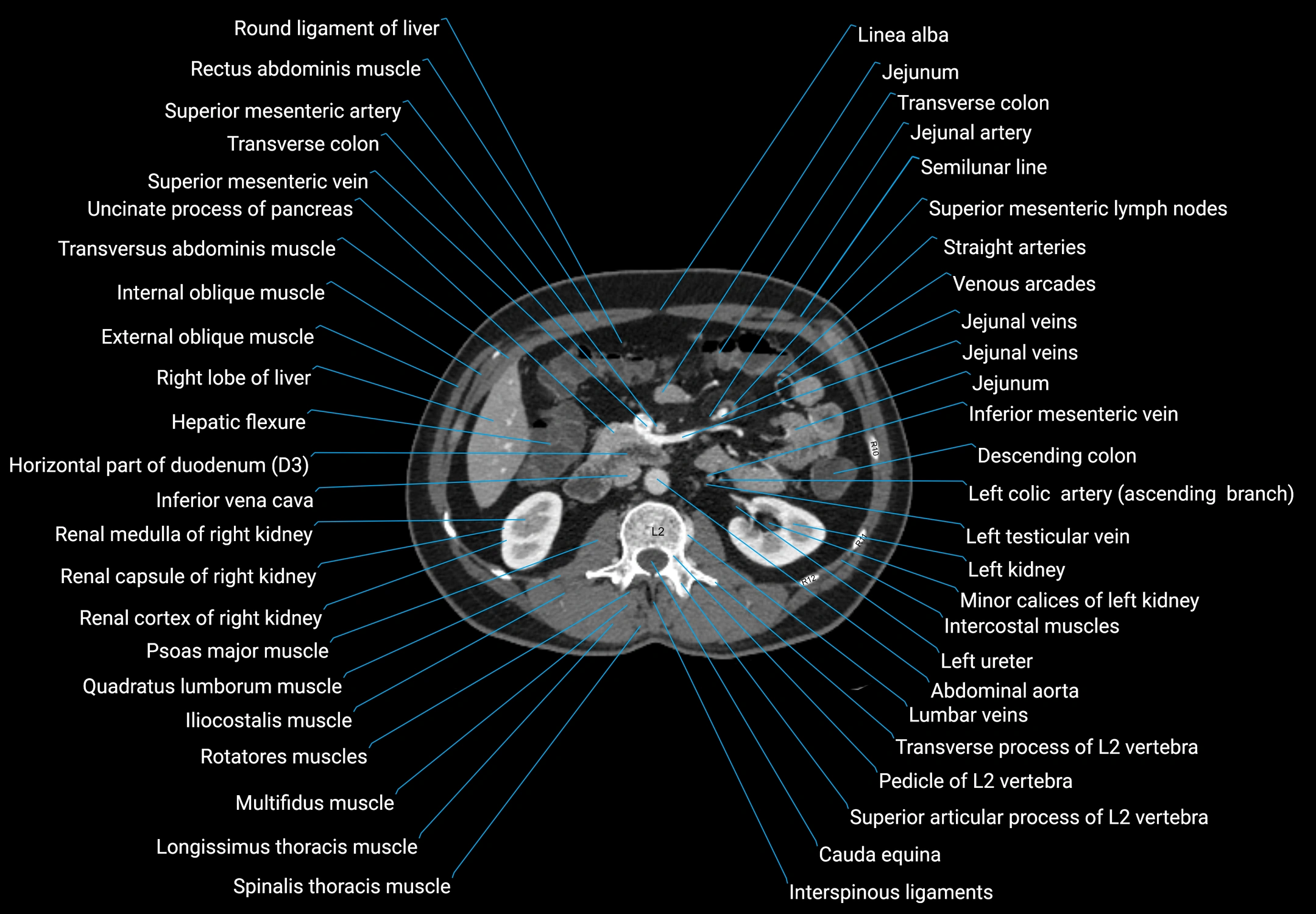 CT male pelvis axial cross sectional anatomy labelled radiology image -00073.webp